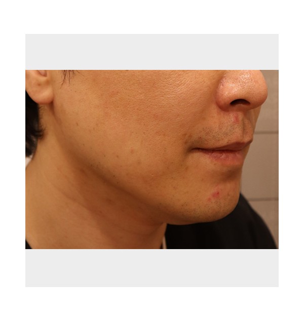 M/50, 리노바 리프팅, 일주일 후