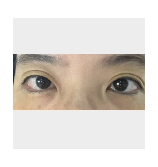 F/39, 아이써마지 450s, 한달 후 (상, 하안검]