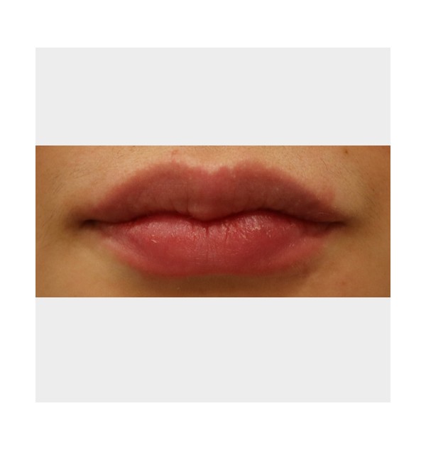 F/30, 입술필러, 직후