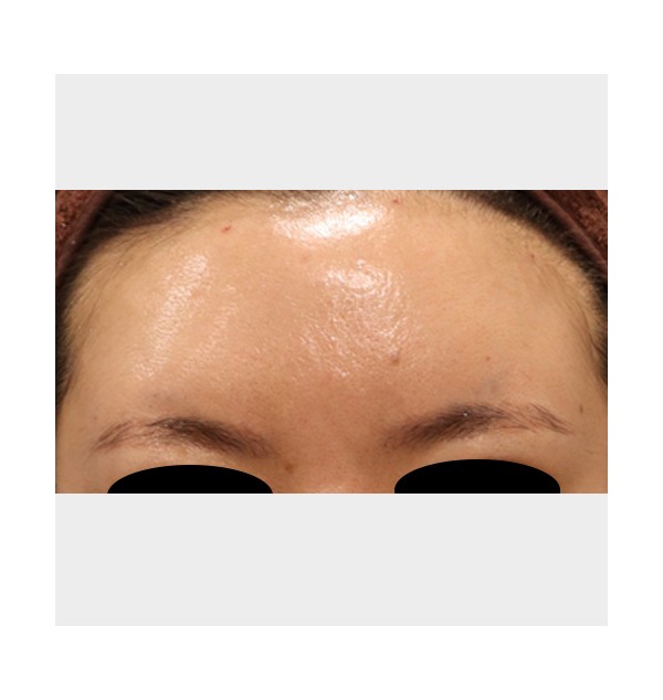 F/33,  타원 시술 이마 필러 미간으로 흘러내려 뭉침         필러 녹이고 이마필…