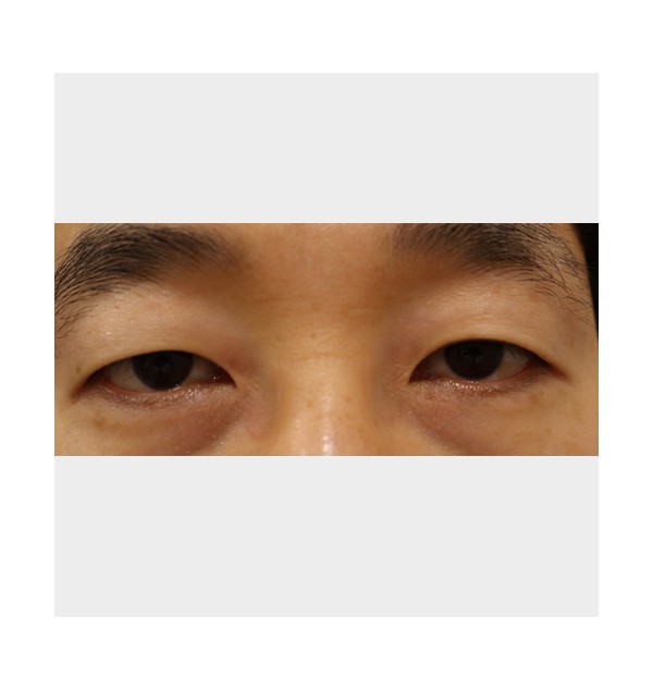 M/40,  아이써마지 450s (상, 하안검]