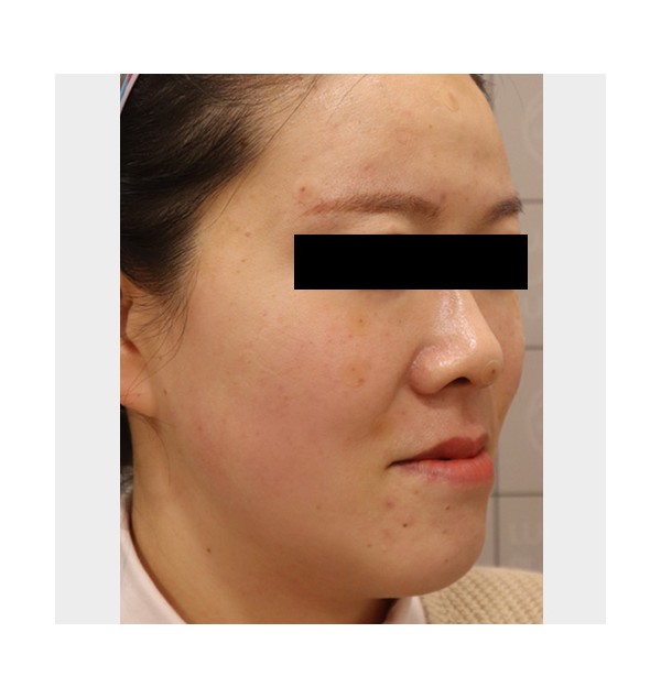 F/30, 주걱턱이 고민 이마, 앞볼 디자인 볼륨 필러