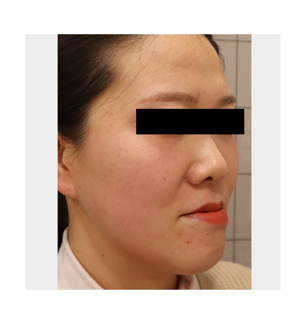 F/30, 주걱턱이 고민 이마, 앞볼 디자인 볼륨 필러
