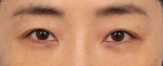 눈밑지방재배치+지방이식 1개월