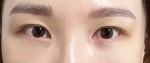 눈밑지방재배치+지방이식