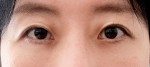 눈밑지방재배치+지방이식 1개월