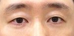 눈밑지방재배치+지방이식(눈밑,앞광대) 3개월