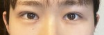 매몰+앞트임+눈밑지방재배치 1개월