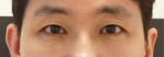눈밑지방재배치+지방이식(눈밑) 2주차