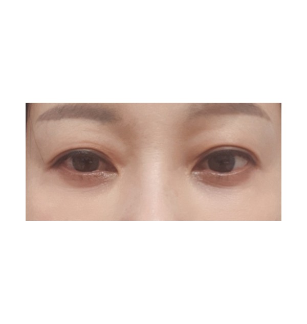 라이트하안검 3개월